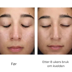 Skinbetter-Science Serum Og Ampuller|Skinbetter AlphaRet Clearing Serum