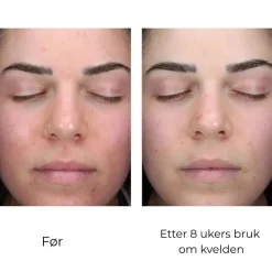 Skinbetter-Science Serum Og Ampuller|Skinbetter AlphaRet Clearing Serum