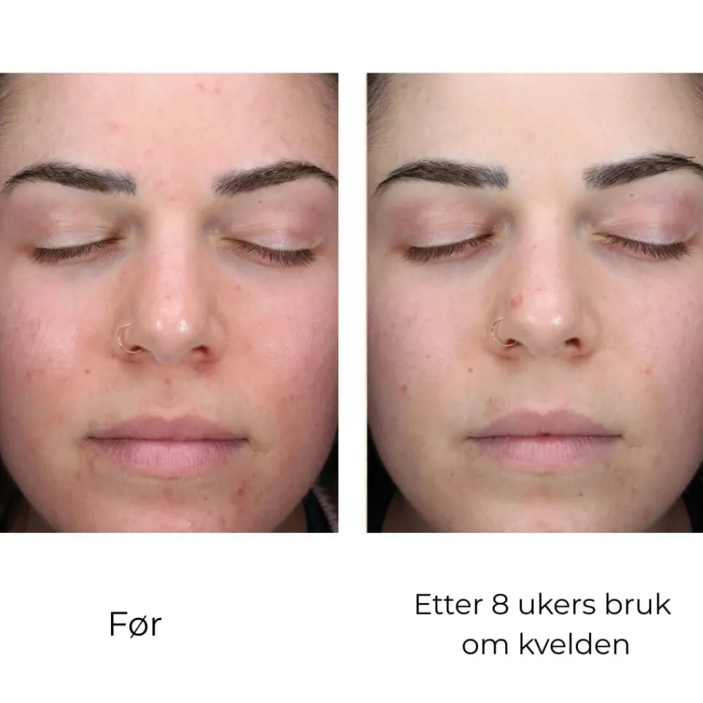 Skinbetter-Science Serum Og Ampuller|Skinbetter AlphaRet Clearing Serum