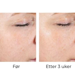 Skinbetter-Science Peeling Og Pads|Skinbetter AlphaRet Exfoliating Peel Pads (30stk)