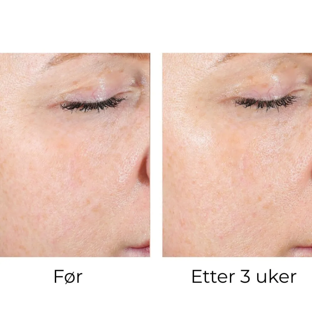 Skinbetter-Science Peeling Og Pads|Skinbetter AlphaRet Exfoliating Peel Pads (30stk)