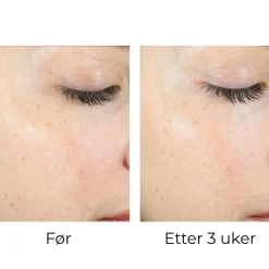 Skinbetter-Science Peeling Og Pads|Skinbetter AlphaRet Peel Pads (1stk)