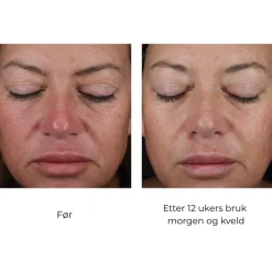 Skinbetter-Science Serum Og Ampuller|Skinbetter Mystro Active Balance Serum