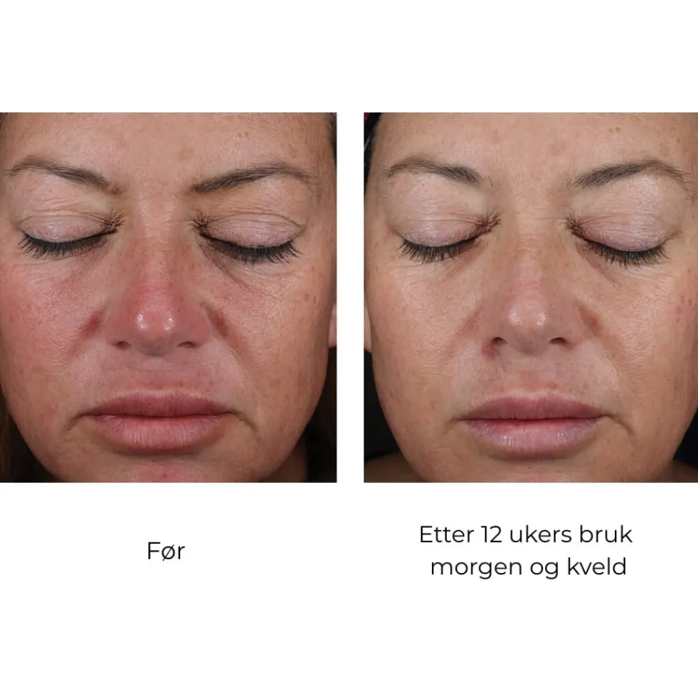 Skinbetter-Science Serum Og Ampuller|Skinbetter Mystro Active Balance Serum