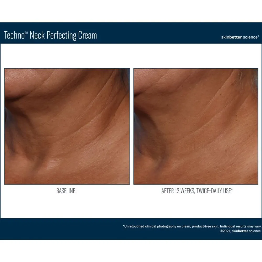 Skinbetter-Science Ansiktskrem|Hals Og Décolleté|Skinbetter Techno Neck Perfecting Cream